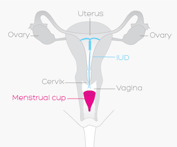 Grafik zur Verwendung der Menstruationstasse, wenn du eine Spirale hast